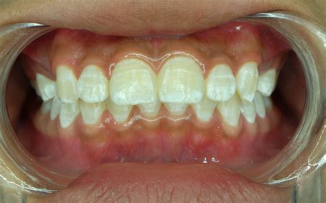 How White Spot Lesions Happen With Braces Kids 360 Pediatric Dentistry
