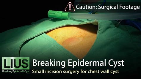 【breaking Epidermal Cyst1】small Incision Surgery For Chest Wall Cyst