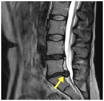 Surely an mri just to rule it out or confirm it isn't harmful, right? I Must Have Slipped A Disc! - Causeway Physio & Pilates