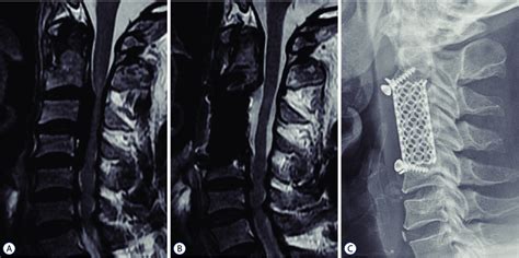 A 64 Year Old Man Who Underwent C3 4 Corpectomy And Reconstruction With