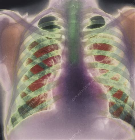 Chronic Bronchitis X Ray Stock Image M1200111