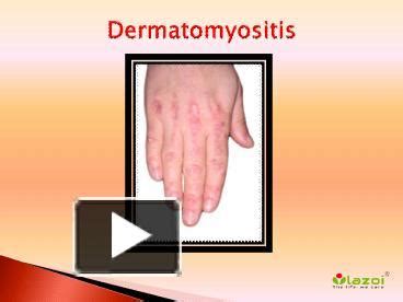 Ppt Dermatomyositis What Are Its Symptoms Causes And Treatment Powerpoint Presentation
