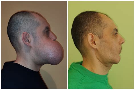 Man Has 3 Pound Tumor Successfully Removed From Face After 20 Years