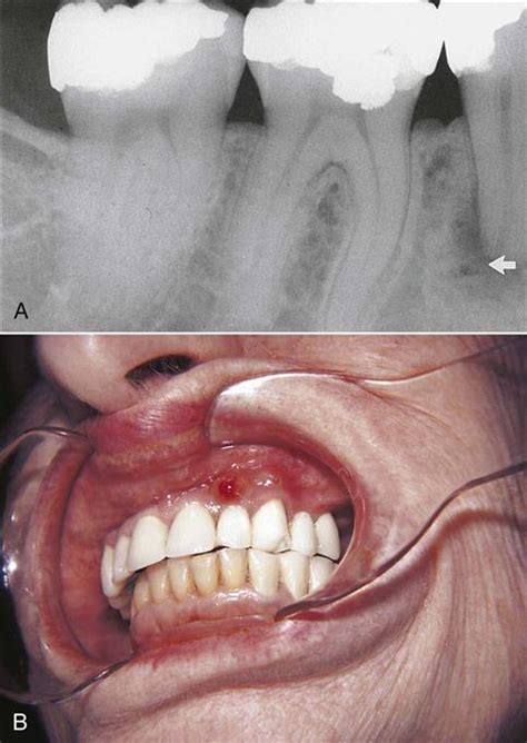 17 Oral Pathology Pocket Dentistry