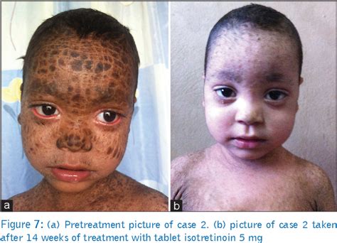 Figure 7 From Successful Outcome Of Lamellar Ichthyosis With Oral