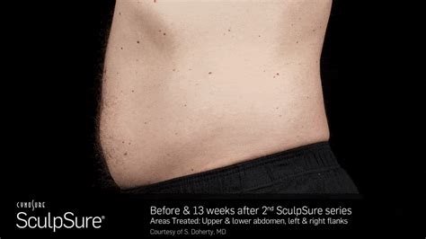 Laser Body Contouring Before And After Sculpsure