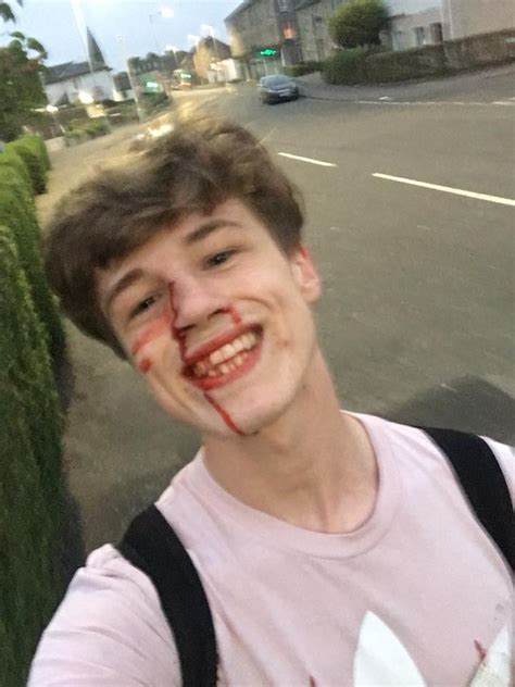 Man Attacked For Being Gay Posts Bloody Yet Smiling