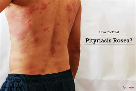 How To Treat Pityriasis Rosea By Dr Rohini P Gaikwad Lybrate