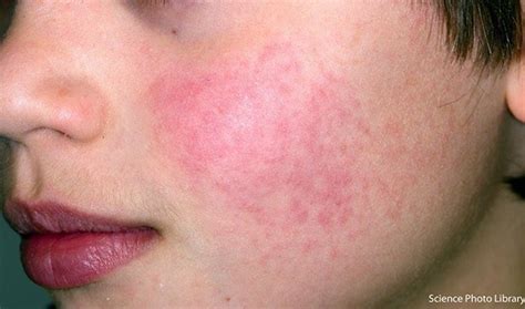 Slapped Cheek Syndrome In Babies And Children Symptoms And Treatment
