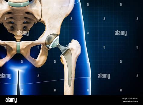 Hip Prosthesis Or Implant Isolated On Blue Background With Copy Space