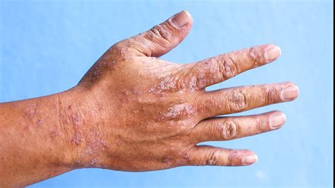 Dry Skin Rash On Hands