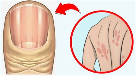 Pionowe bruzdy na paznokciach zwiastują choroby Oto co oznaczają