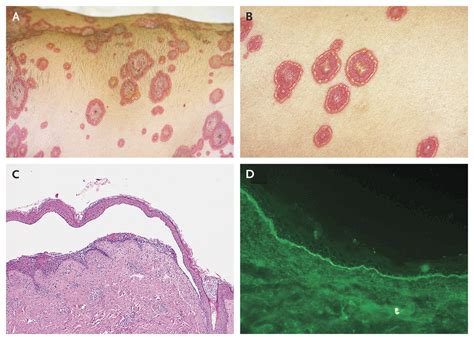 Linear Iga Bullous Disease — Nejm