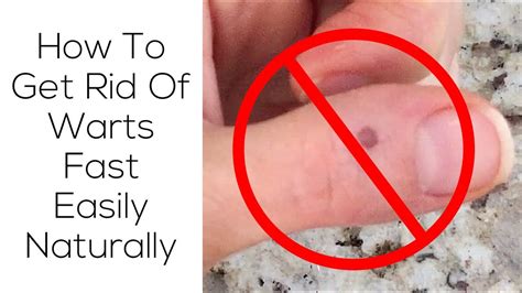 How To Get Rid Of Warts Fast Easily Naturally Youtube