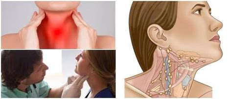 Ganglios Inflamados en el Cuello Características Causas Síntomas Tratamiento y Duración de