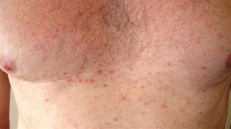 Dermatoses Causes Treatments And More