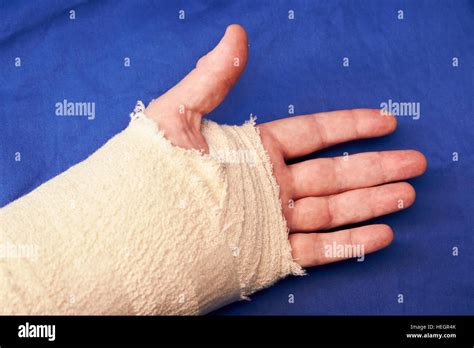 Bandagierte Linke Hand Nach Verletzungen Karpaltunnel Operation