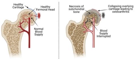 Avascular Necrosis Of The Femoral Head Treatment Symptoms Causes