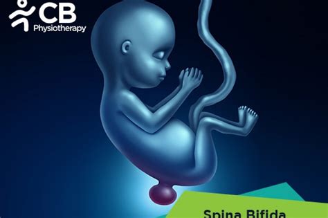 What Is Spina Bifida Symptoms Causes Diagnosis Physiotherapy