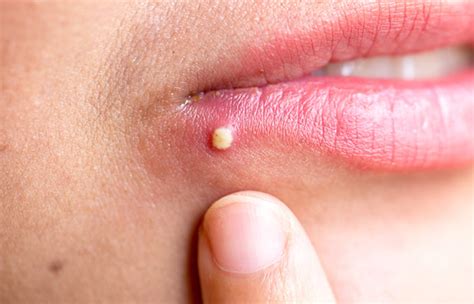 Cold Sore Vs Pimple Årsaker Symptomer Og Behandling Jidian Stone