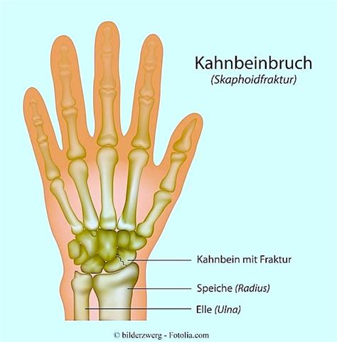 Beispielsweise ein aufprall oder sturz kann die finger relativ schnell brechen. Handschmerzen, Nerven, rechts oder links, innen, Daumen ...