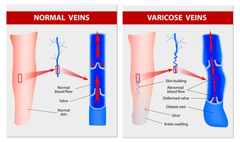 If veins are painful or bleeding, or if the area is swollen, see your. What are Varicose Veins and How To Treat Them? - Aesthetics Hub