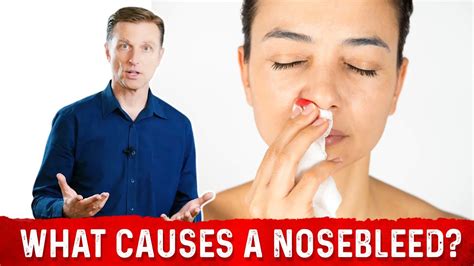 What Causes Nosebleedsepistaxis 8 Common Causes Of Nose Bleeding Dr Berg