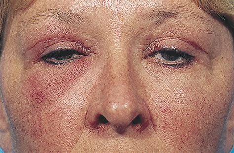 Development Of Graves Orbitopathy After Blepharoplasty A Rare