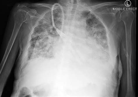 Pulmonary Consolidation Chest X Ray Medschool