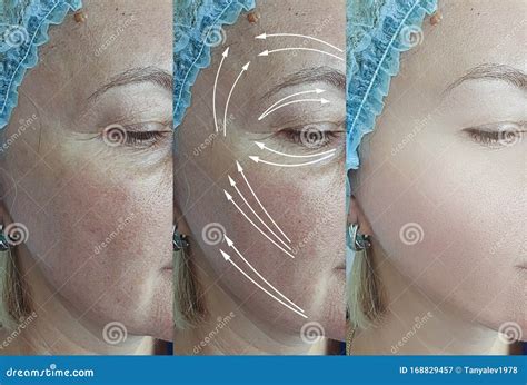 Woman Face Wrinkles Aging Revitalization Difference Therapy Before And