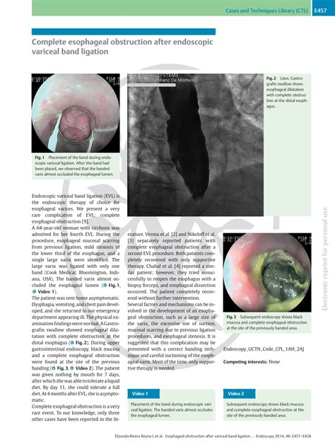 Pdf Complete Esophageal Obstruction After Endoscopic Variceal Band