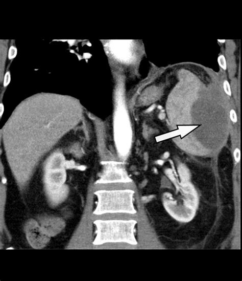 Ct Guided Percutaneous Drainage Of A Splenic Abscess Case Report And