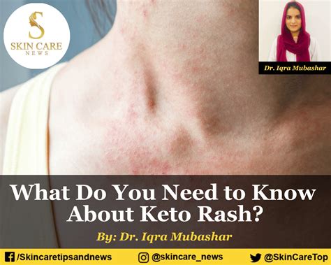 What Do You Need To Know About Keto Rash On Body
