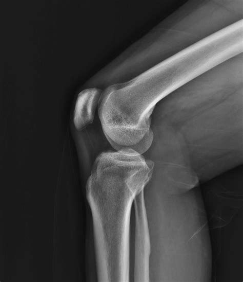 Radiograph Of Lateral Knee Joint Captured In Conventional Position