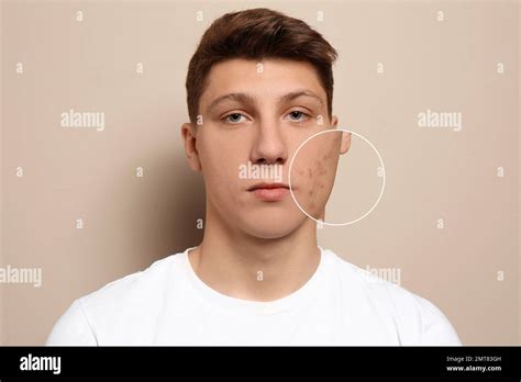 Teenage Boy With Acne Problem On Beige Background Stock Photo Alamy