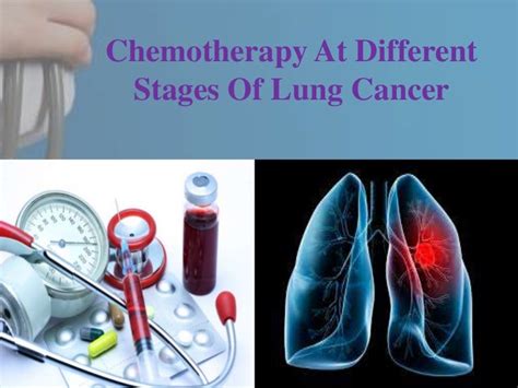 Chemotherapy At Different Stages Of Lung Cancer