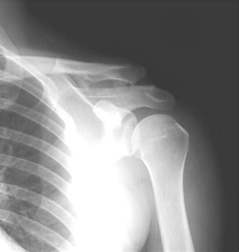 The clavicle is unstable to direct stress examination. Preoperative upright AP radiograph of the left shoulder of ...
