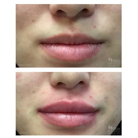 Juvederm In The Lips Before And After Lipstutorial Org