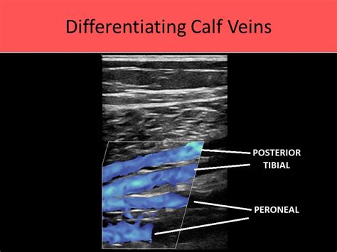Gastrocnemius Vein Anatomy Ultrasound Venous Incompetence Ultrasound