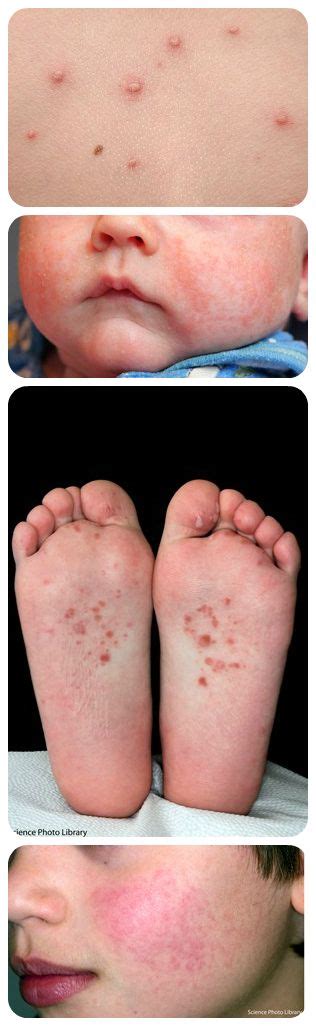 Childrens Rashes And Spots In Pictures Toddler Health Kids Health