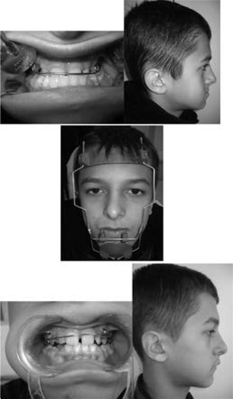 A Patient Before Treatment B Delaire Facial Mask C Patient After