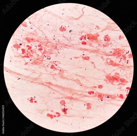Smear Of Sputum Specimen Grams Stained Under 100x Light Microscope