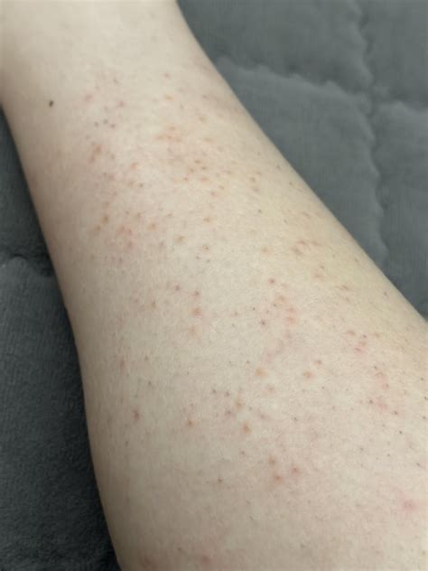 Itchy Red Bumps 2 Days After Laser Hair Removal Rhairremoval