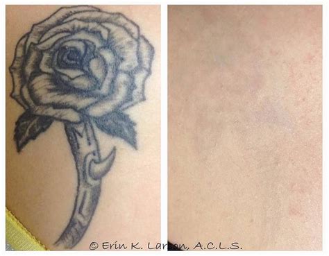 Before And After Tattoo Removal Using The Harmony Xl Pro Platform