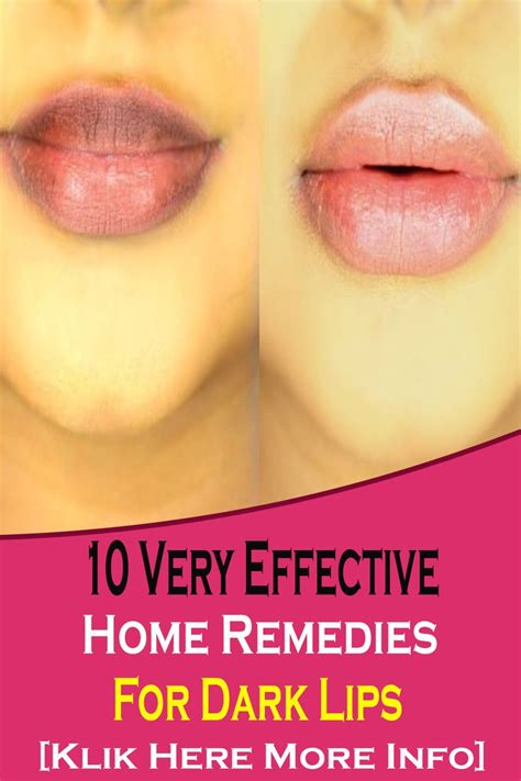 10 Very Effective Home Remedies For Dark Lips In 2020 Remedies For