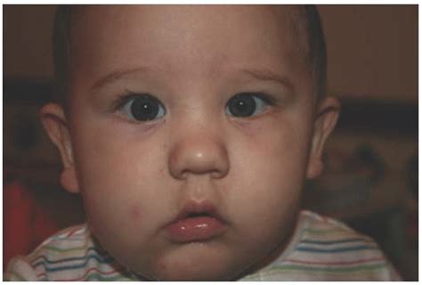 Skin tags in front of eyes; Flat Nasal Bridge And Epicanthal Folds - Trisomy 21 Docx Autism Down Syndrome : It is very ...