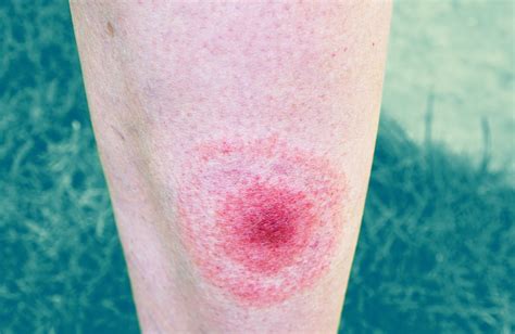 What Does A Lyme Disease Rash Really Look Like These Pictures Explain