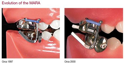 We did not find results for: AOA, customizing the MARA™ since 1994 - Product Profile ...