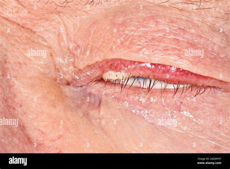 Chalazion Abscess On An Eyelid In A Year Old Man This Condition