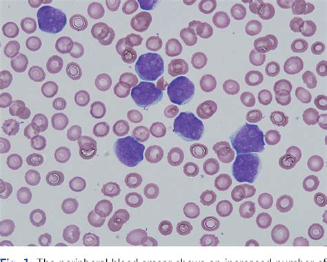 Pdf Cd5 Negative Blastoid Variant Mantle Cell Lymphoma With Complex